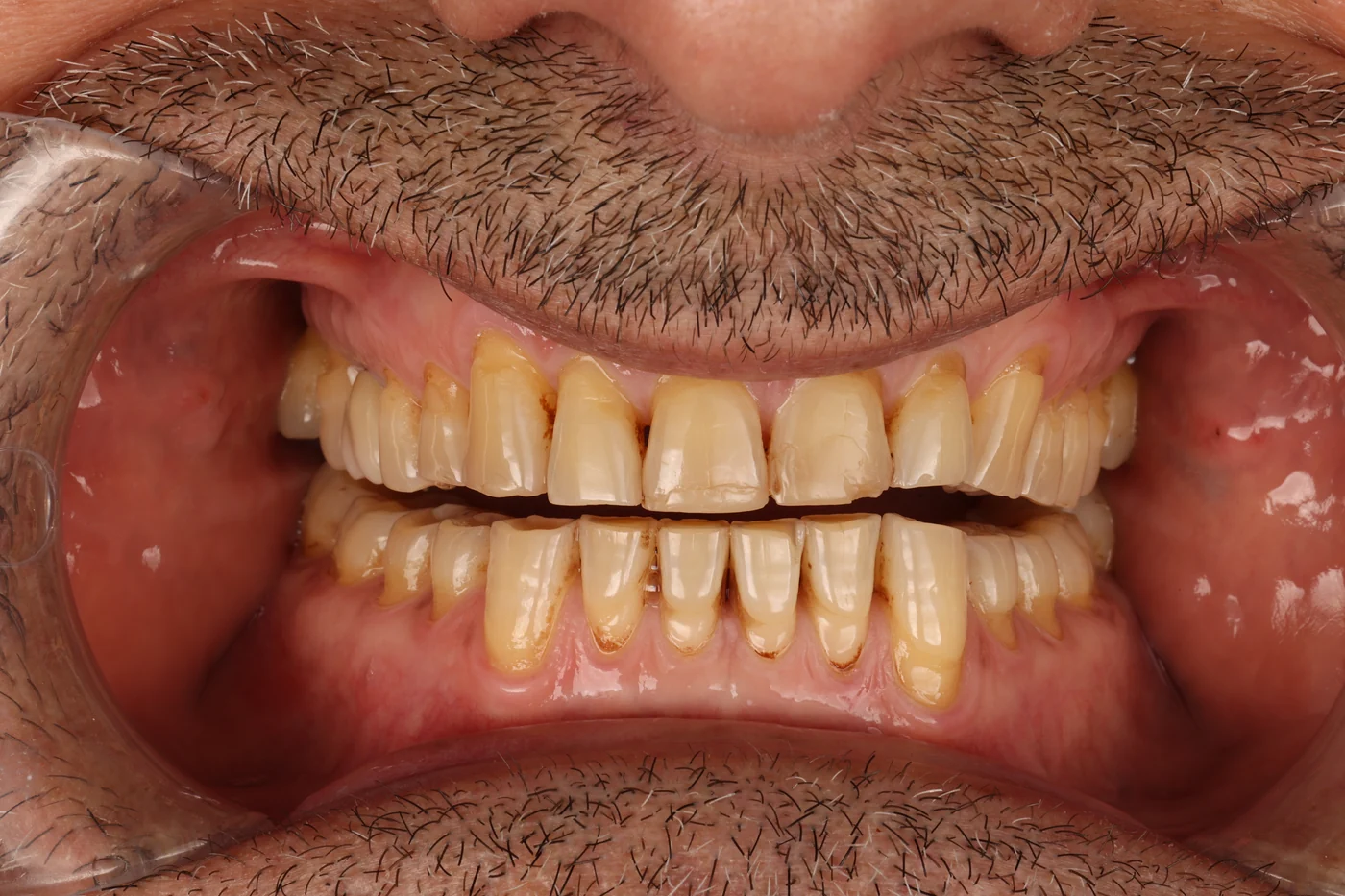 The same smile before treatment