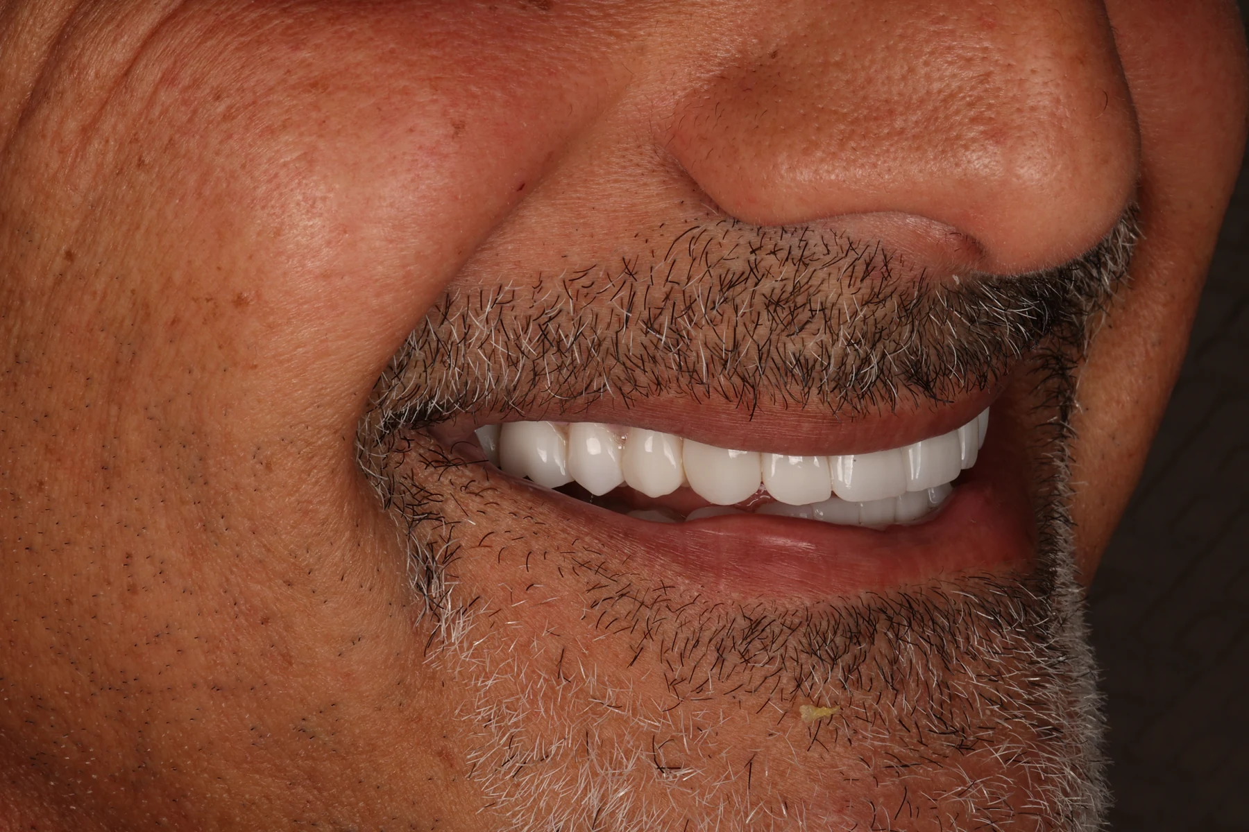 Completed smile, side profile