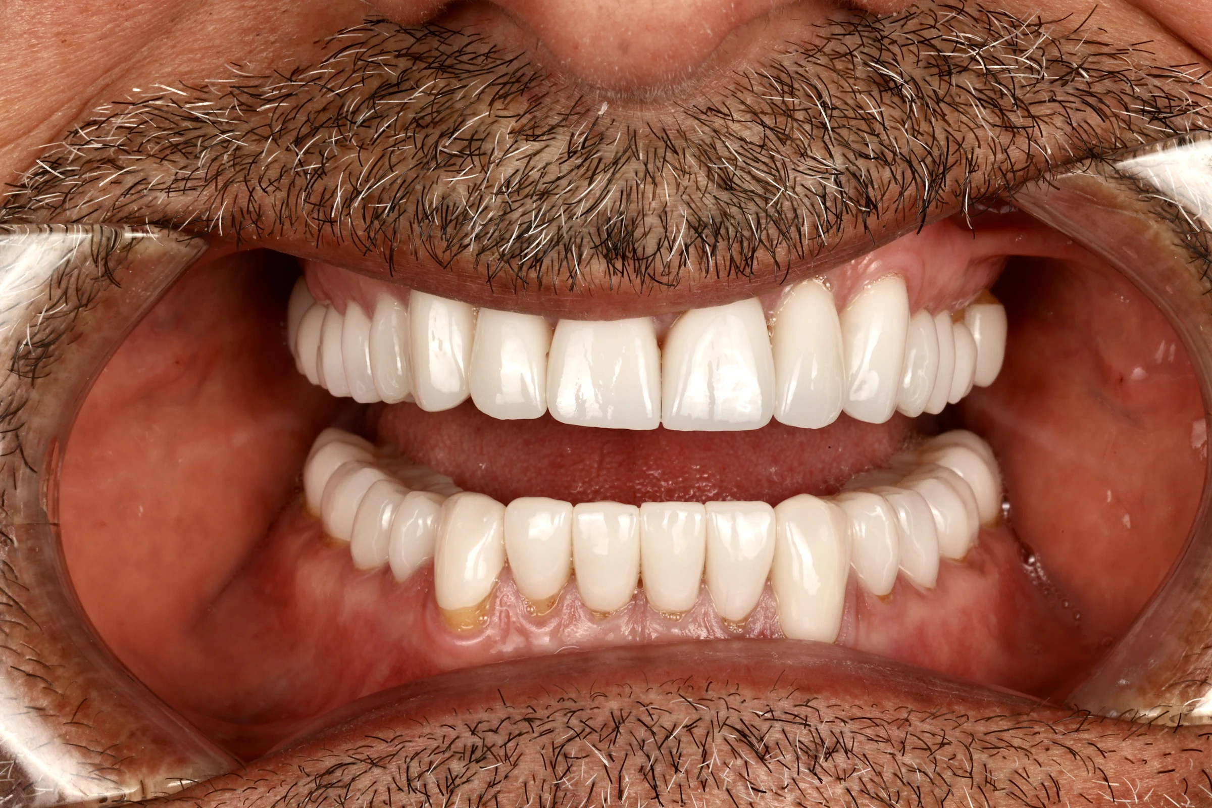 Completed smile, front view