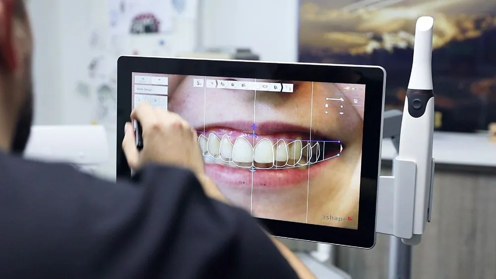 A live digital smile design session at The Veneer Clinic